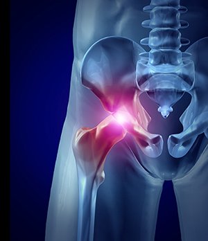 Hip Pain Management and Hip Surgery Apex Surgeons Arizona
